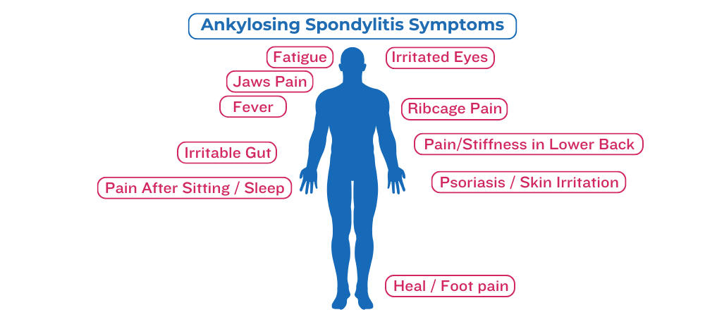 ankolysing sponsylitis symptoms