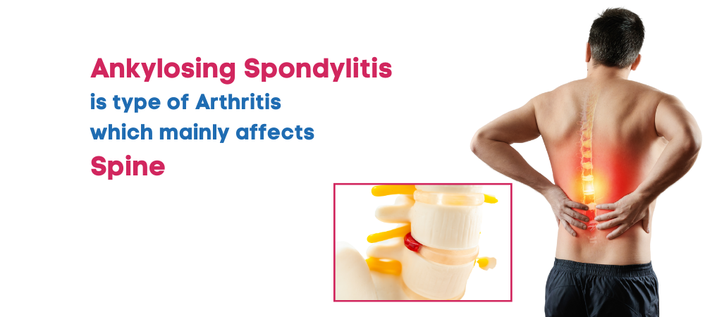 spondylitis