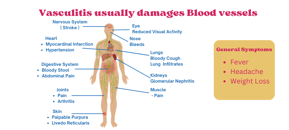 vasculitis-symptoms